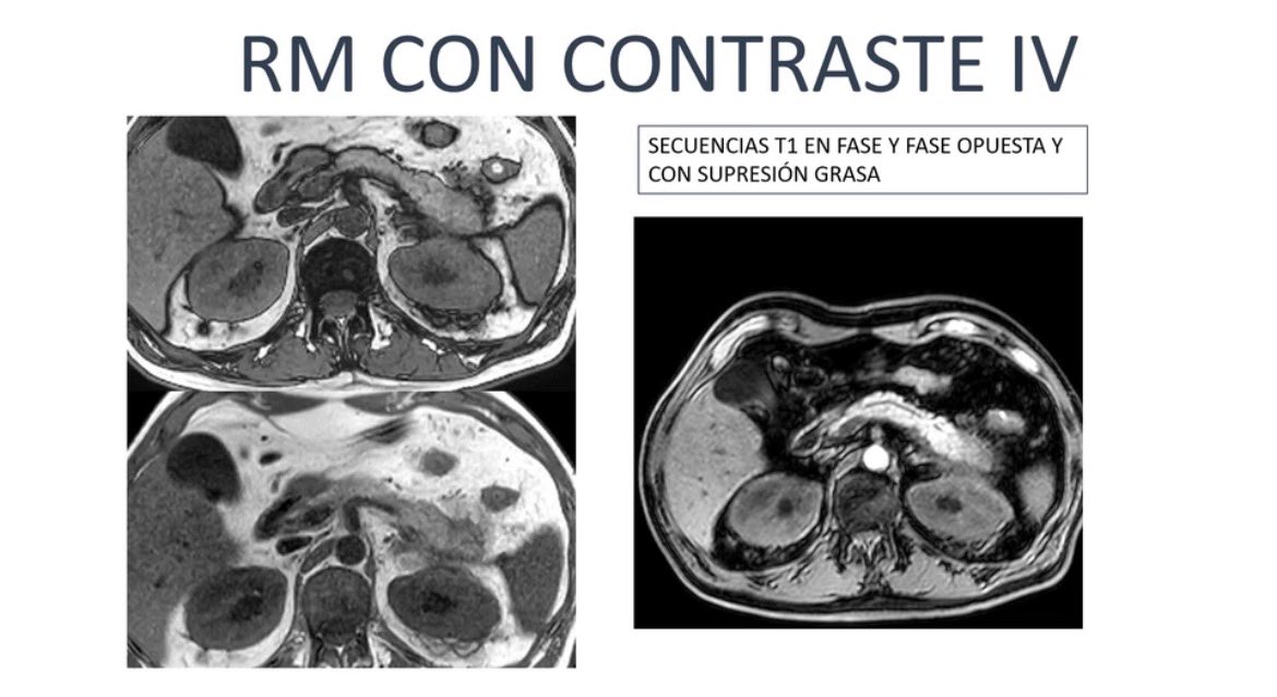 sediabdomen's tweet photo. Has visto ya el nuevo #casosedia del mes de Abril?
Puedes verlo en https://t.co/BONPVBN3fF y si sabes la respuesta envíala a info@sedia.es. Puedes ganar una inscripción para el proximo #congresosedia https://t.co/iriaZLnPPC