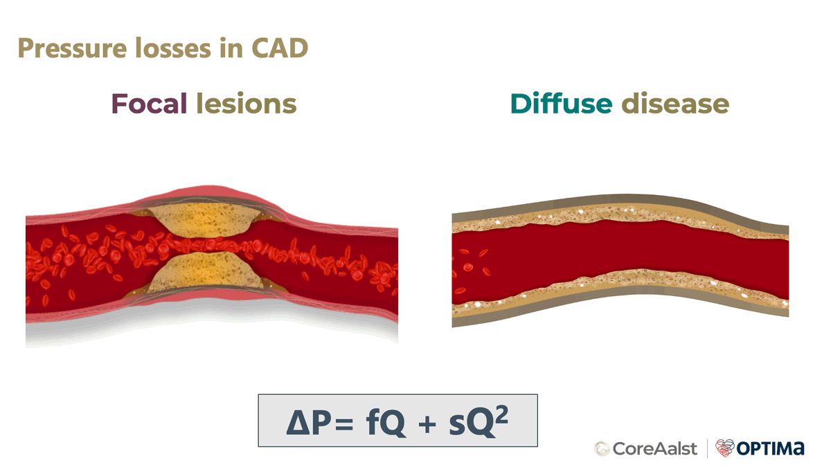 CoreAalst's tweet photo. 🌟 Dr Carlos Collet presents: 

P R E S S U R E   P U L L B A C K   G R A D I E N T
( P P G ) : 
enhancing your decision making 

The Physiology Course 16th edition: A New Wave!
🗓️ April 15-17, 2024
📍 @orsiacademy Belgium

🔗 https://t.co/GnXGM0ZytM

#ANewWave
#ORSIAcademy
#TPC24
#CoronaryPhysiology

@bernardBruyne
@CardioAalst
@ColletCarlos
@DamienCollison
@divaka_perera
@DrAllenJ
@DrKeeble
@DrNataliaP
@EAPCIPresident
@egutiMD
@ESHLOF
@hect2701
@Hragy
@jeroen_sonck
@JEscaned
@monaltiren
@nicolasamabile
@OLVZaalst
@OPCILive
@OptimaCTO
@rallamee
@wfearonmd
@ziadalinyc
@OptimaCTO