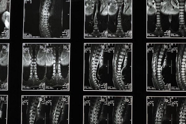 Myelopathy org tweet media