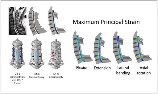🔍 Don’t miss the full picture in battling Degenerative Cervical Myelopathy (DCM)! Spinal cord compression is crucial, but let’s not forget about the effects of stress and strain during neck movement. Read more: myelopathy.org/modeling-the-s… #DCMawareness #Neurology #MedicalResearch