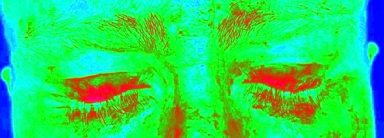 Want to be able to clearly show your patients just how bad their ocular rosacea is? Our prototype rosacea app can help you do just that - reach out if you'd like more info..
#ocular #rosacea #dryeye