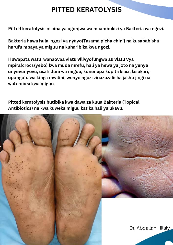 Elimika kuhusu ugonjwa wa ngozi na hurufu mbaya ya miguu.