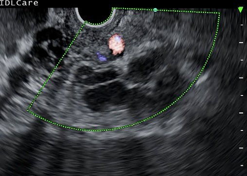 How to minimize the number of coils for gastric varices. Search for feeder vessel as seen in first photo. Deploy a single coil just beyond the feeder in the varix. You may not need any more coils. We needed 1/2 cc additional Glue to block a small patent vessel after coiling