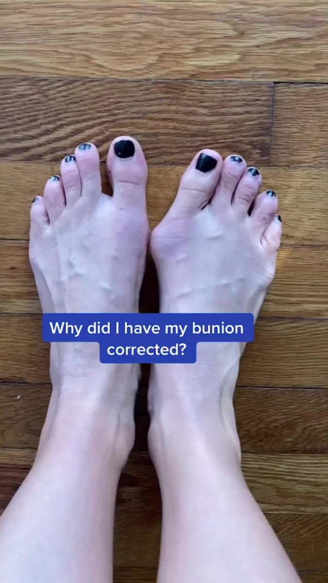 Seeking bunions survivors and support in my journey! 💪 8 months post-lapiplasty, getting prepped for round 2. No pain-free days yet, but hopeful for better mobility soon. 🦶 #BunionsSurgery #RoadToRecovery #bunion… halluxcare.com #bunion #bunionpain #tailorsbunion
