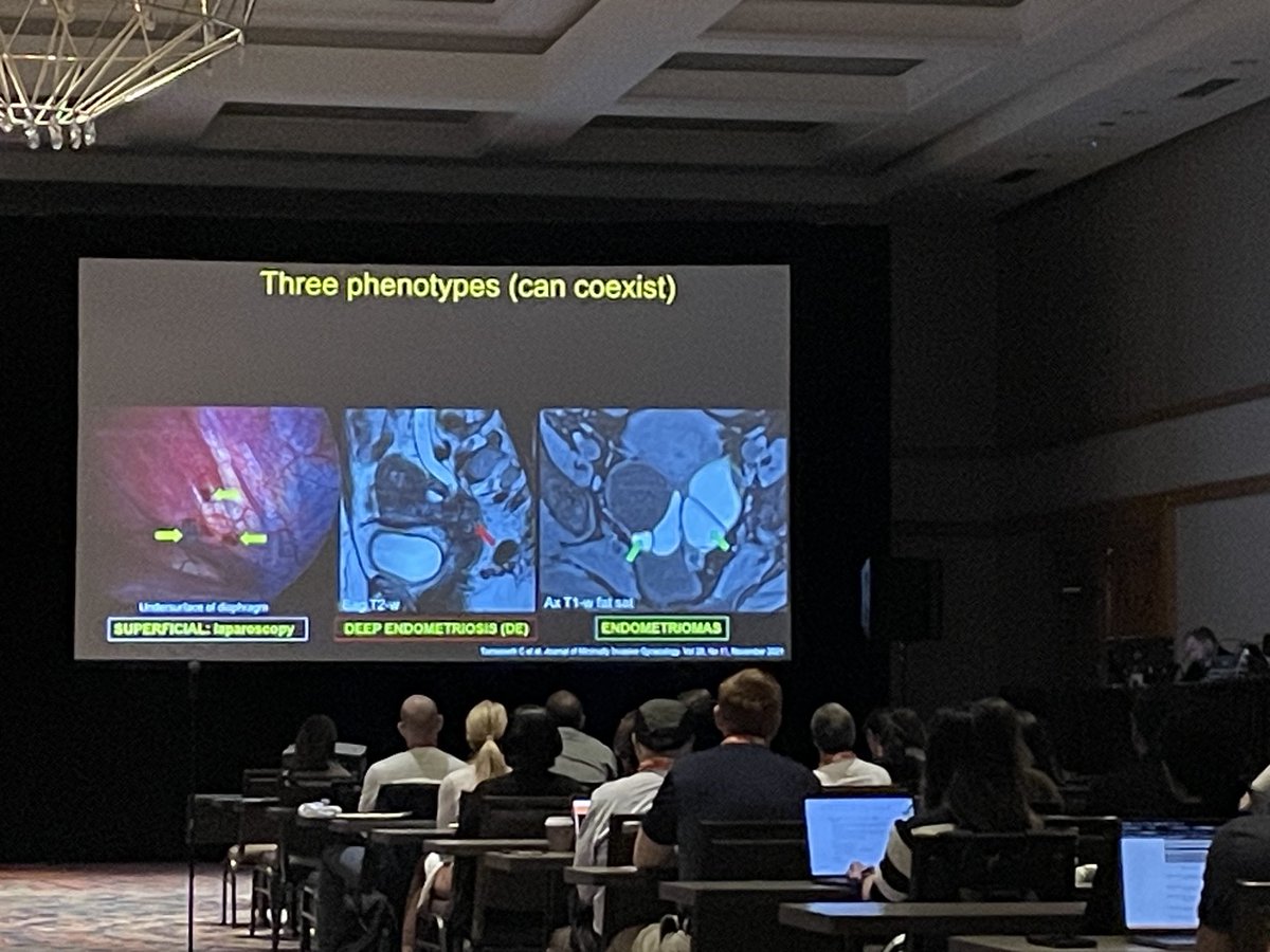 ⁦excellent discussion on deep pelvic endometriosis by ⁦@ASBEpic⁩ #sar24