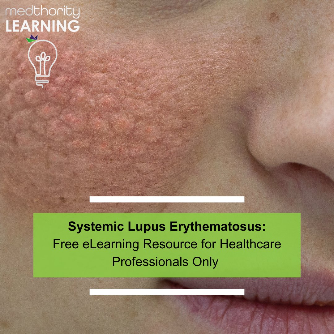 Improve your ability to recognise and treat systemic lupus erythematosus (SLE) with bitesize quizzes and expert insights, only on Medthority. ➡️ ow.ly/kOCk50R3pjE #MedTwitter #NurseTwitter #CME #IME #MedEd