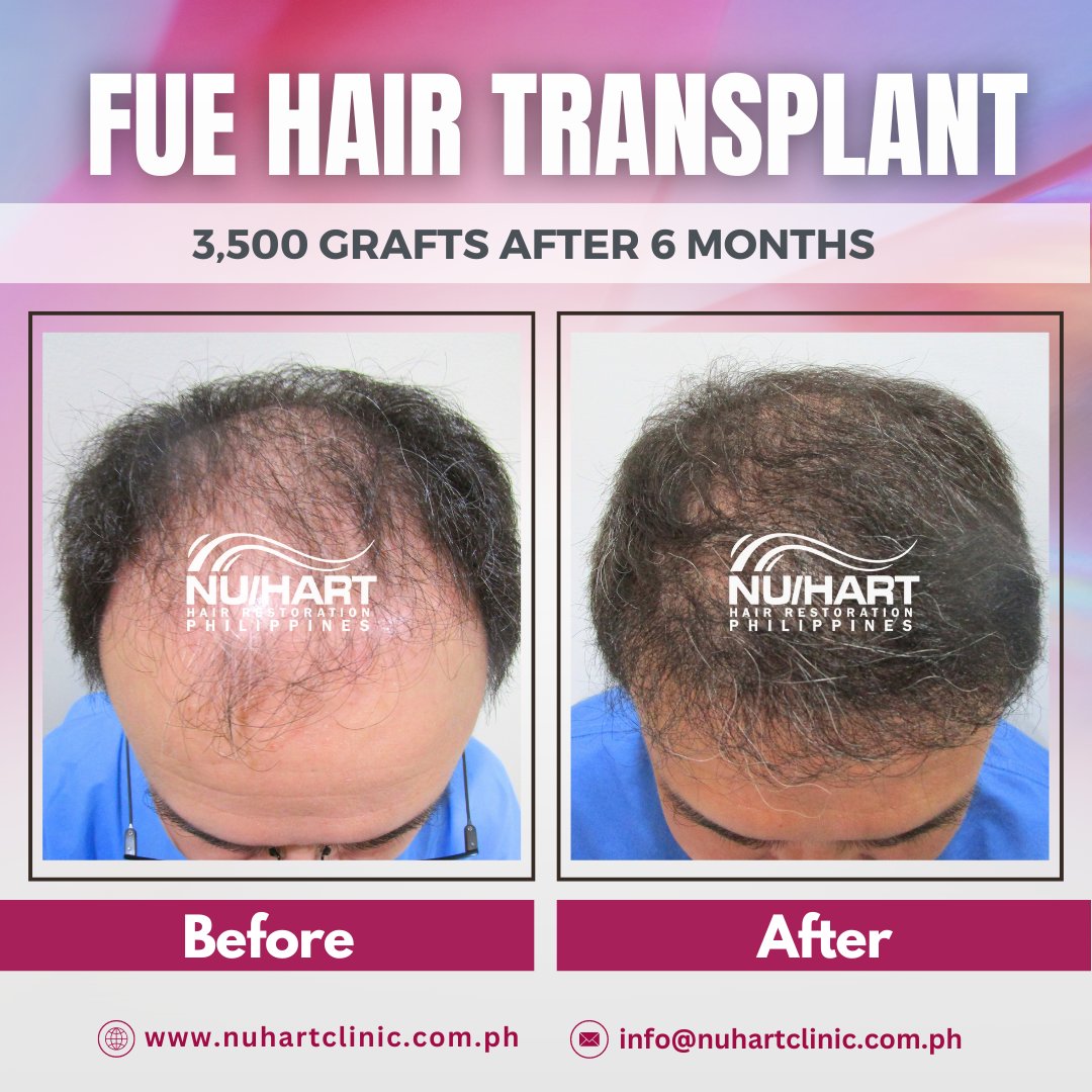 Sharing the amazing results of our patient 𝟲 𝗺𝗼𝗻𝘁𝗵𝘀 𝗮𝗳𝘁𝗲𝗿 his 𝗙𝗨𝗘 𝗵𝗮𝗶𝗿 𝘁𝗿𝗮𝗻𝘀𝗽𝗹𝗮𝗻𝘁, 𝘄𝗶𝘁𝗵 𝟯,𝟱𝟬𝟬 𝗴𝗿𝗮𝗳𝘁𝘀.

Get in touch today for a 𝗙𝗥𝗘𝗘 𝗼𝗻𝗹𝗶𝗻𝗲 𝗰𝗼𝗻𝘀𝘂𝗹𝘁𝗮𝘁𝗶𝗼𝗻!

#hairrestoration #hairtreatment #hairtransplant