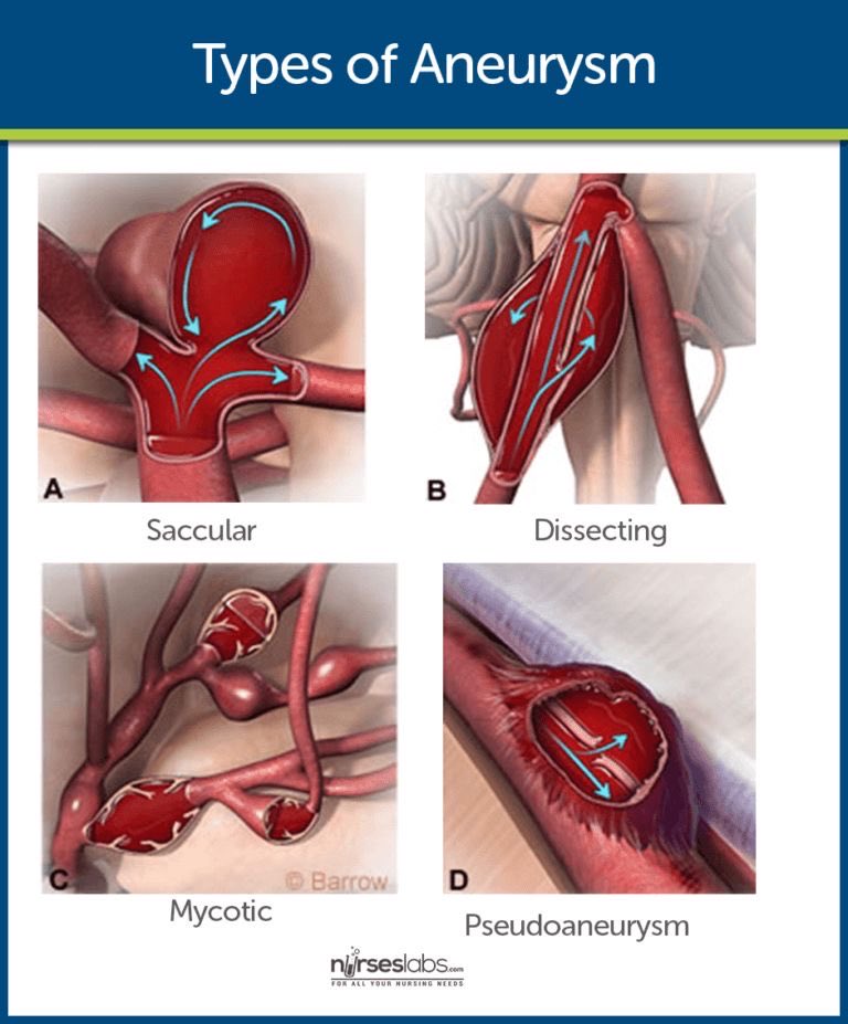 Types of aneurysms