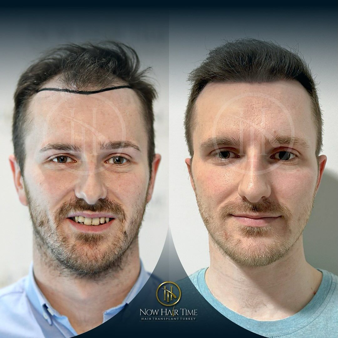 Hair Transplant Before After! 

#hairtransplant #haartransplant #turkeyhairtransplant #haartransplantatie #hairtransplantation #fuehairtransplant #beardtransplantation #beardtransplant #hairtransplantresults #hairtransplantresult #nowhairtime #nowhairtimeturkey