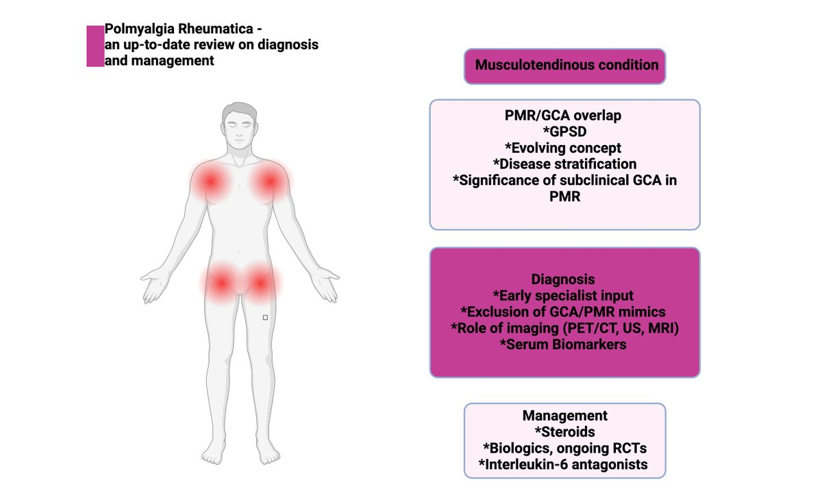 Vessel_Plus's tweet photo. ๐Share a review article
"#Polymyalgia #rheumatica - an up-to-date review on diagnosis and management"
๐https://t.co/FryccbVdMm #vasculitis https://t.co/M1AEF6JnFG