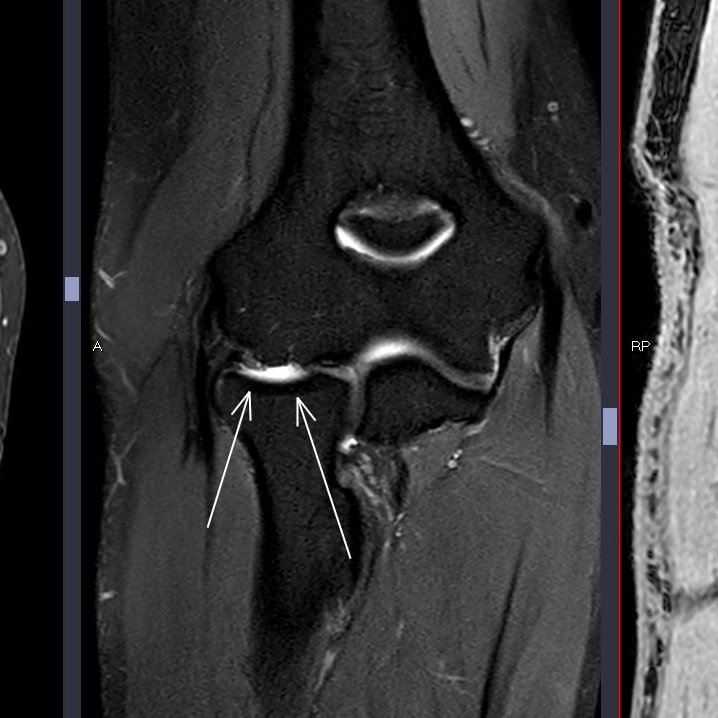 15/4/2024.🟠Male 34 yo with radial-sided #elbow 💪 pain, clinically characterised of epicondylitis. Is this a 1⃣ normal variant of anatomy or 2⃣pathology? 🦴What's the name of this finding? Give your thoughts and stay tunned. #MSK #traumatwitter #orthotwitter