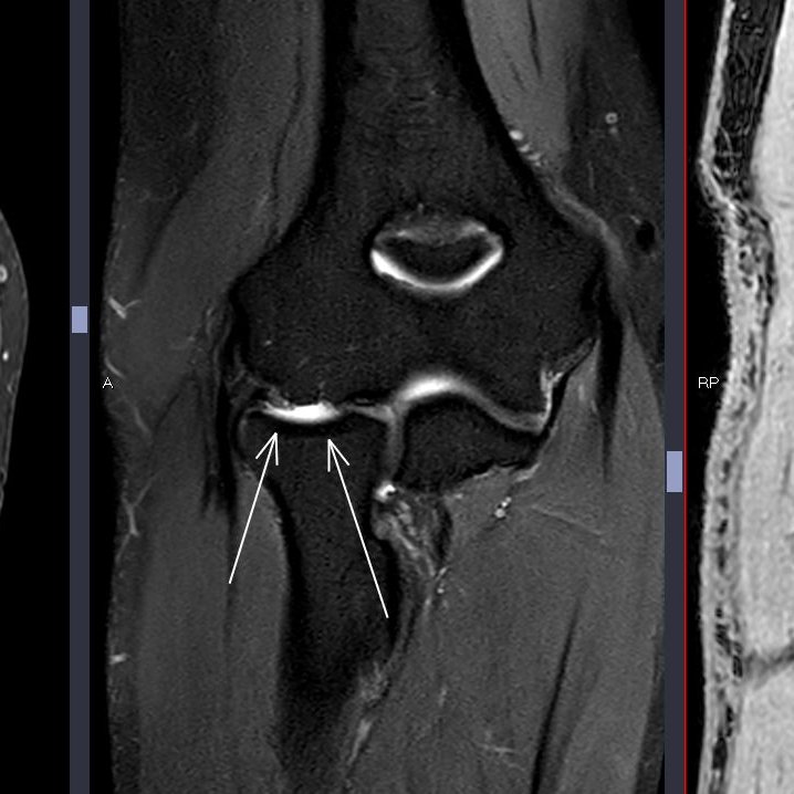 themskarchive's tweet photo. 15/4/2024.🟠Male 34 yo with radial-sided #elbow 💪 pain, clinically characterised of epicondylitis. Is this a
1⃣ normal variant of anatomy or
2⃣pathology?
🦴What's the name of this finding?
Give your thoughts and stay tunned. #MSK #traumatwitter #orthotwitter https://t.co/b7O4TpMdV6