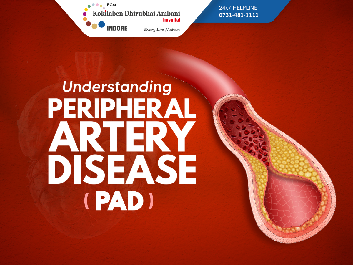 Peripheral Artery Disease (PAD) narrows arteries, reducing limb blood flow, causing leg pain, numbness, weakness. Untreated PAD can lead to infections, amputation. Consult your doctor for symptoms. #PeripheralArteryDisease #VascularHealth #LegPain