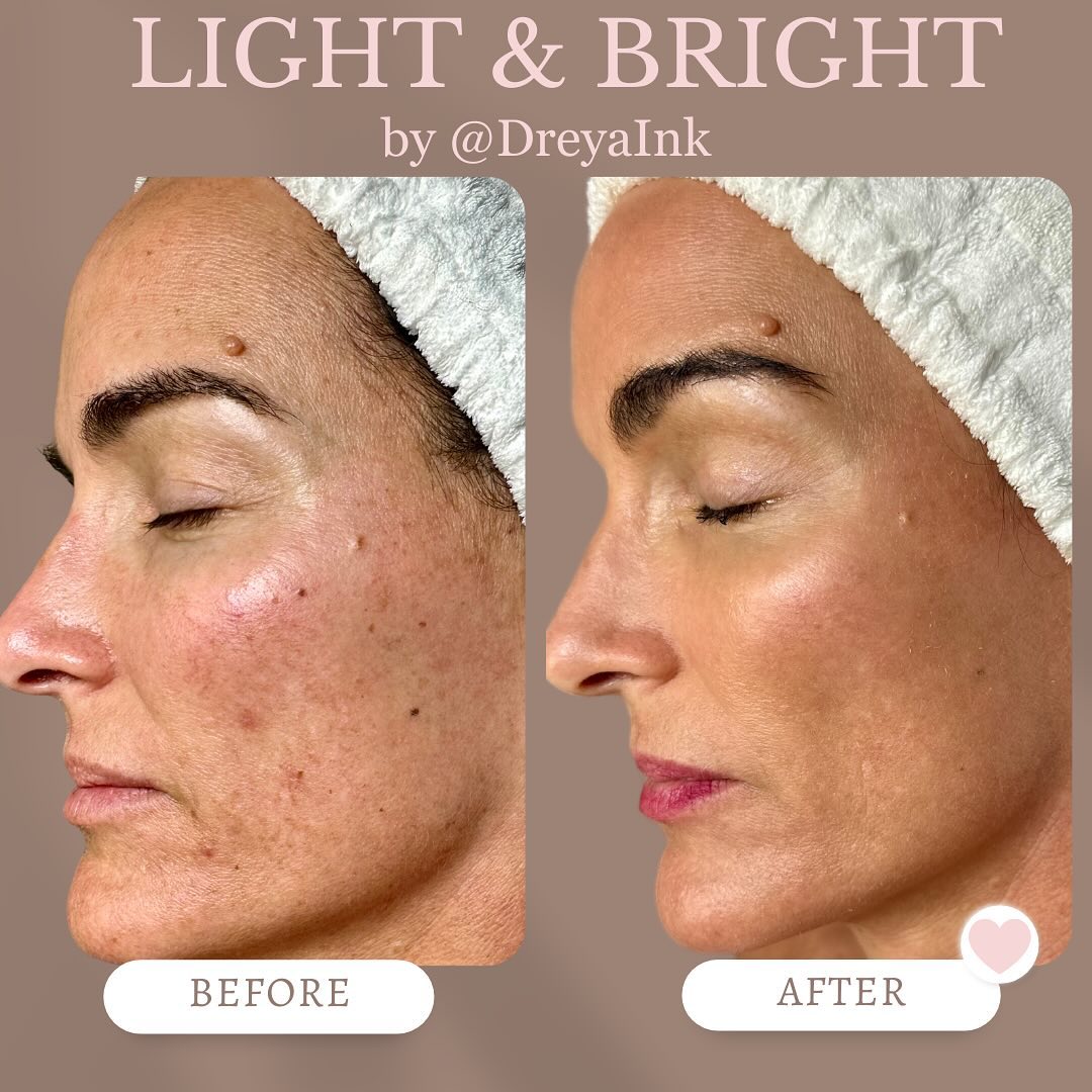 CandelaMedical1's tweet photo. Another fantastic result from Dreya Ink after treating her client using the Nordlys® 'Light & Bright' treatment...
*After photos were taken 4 weeks post.
REPOST @dreyaink
Don’t just reset the clock, we turn it backkkkkk!
#Nordlys #LightandBright #Candela #SkinRejuvenation https://t.co/R6ayytRZx1