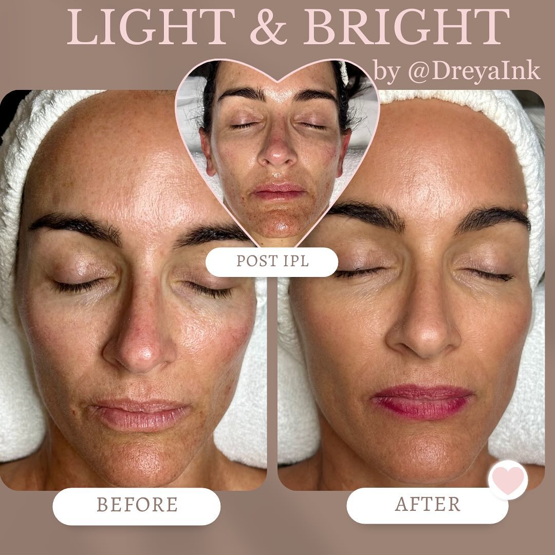 CandelaMedical1's tweet photo. Another fantastic result from Dreya Ink after treating her client using the Nordlys® 'Light & Bright' treatment...
*After photos were taken 4 weeks post.
REPOST @dreyaink
Don’t just reset the clock, we turn it backkkkkk!
#Nordlys #LightandBright #Candela #SkinRejuvenation https://t.co/R6ayytRZx1