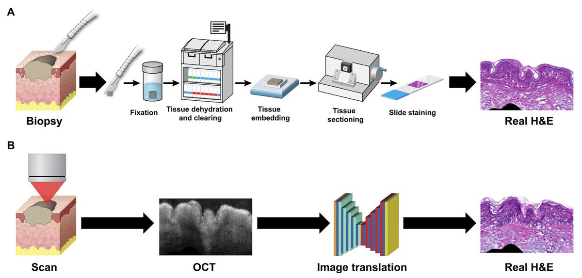 SCI members @adamdelazerd, @yowinetraub, Kavita Sarin, & others developed a noninvasive #VirtualBiopsy using micro-registered optical coherence tomography. bit.ly/3xA0JSb