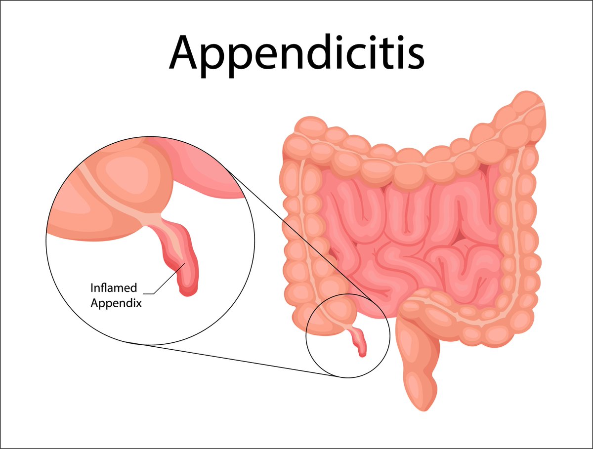 Join us for a discussion on the challenges of acute appendicitis in surgery - from diagnosis to complications. Experts will tackle tough cases & share insights! #appendicitis #surgerychallenges
▶️bit.ly/acute_appendic…
@Richard_J_Guy
@MichaelThornto8
@bbharathan2
@asgbi