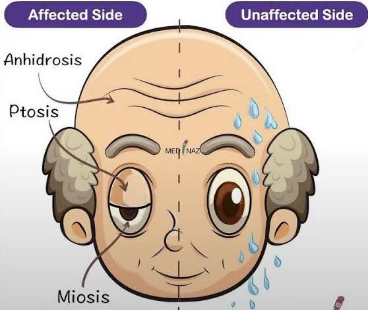 Horner’s syndrome