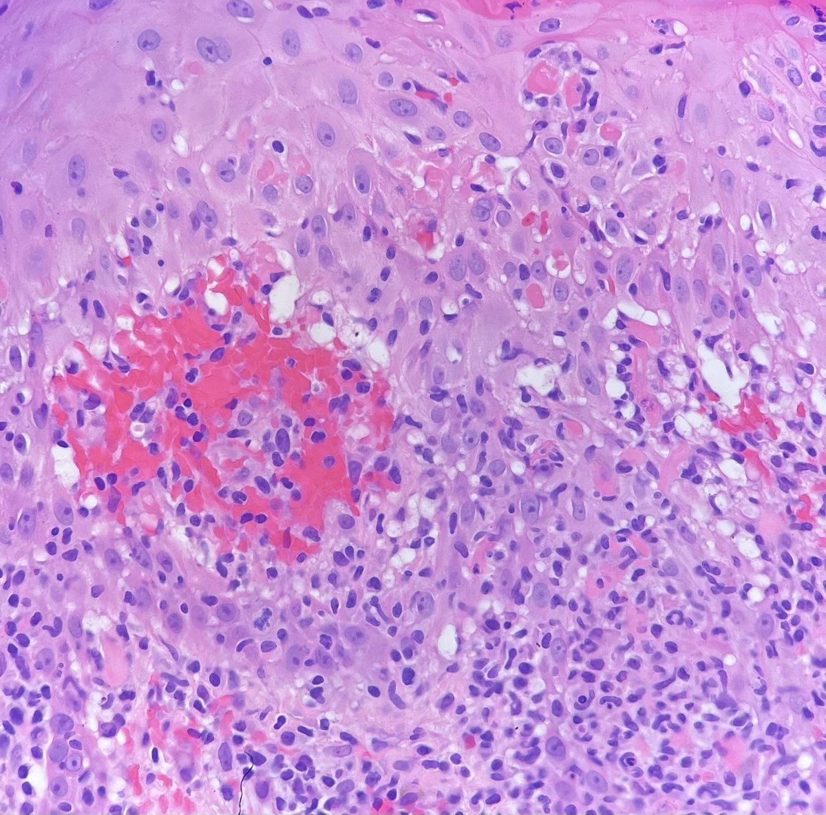 redsnapperpath's tweet photo. Coming in just a little too hot for a Monday morning 🌄 🥵🥵🥵🚑🚑🚑- eruption post MMR vaccine 💉, multiple erythematous vesiculopustular and necrotic lesions - 7 YOF #dermpath #pathtwitter #dermatología #dermatology https://t.co/n63w5qSWhD