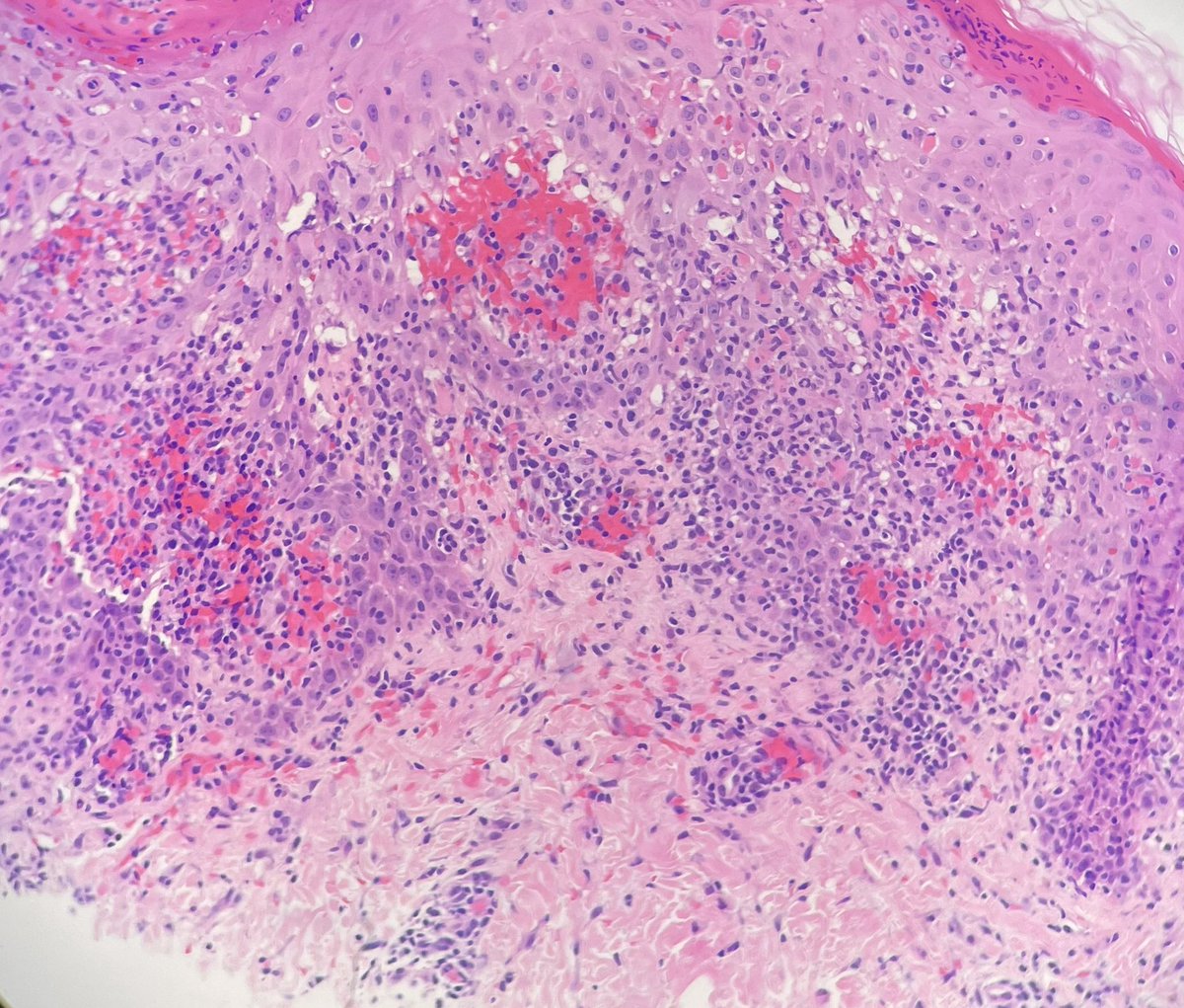 redsnapperpath's tweet photo. Coming in just a little too hot for a Monday morning 🌄 🥵🥵🥵🚑🚑🚑- eruption post MMR vaccine 💉, multiple erythematous vesiculopustular and necrotic lesions - 7 YOF #dermpath #pathtwitter #dermatología #dermatology https://t.co/n63w5qSWhD