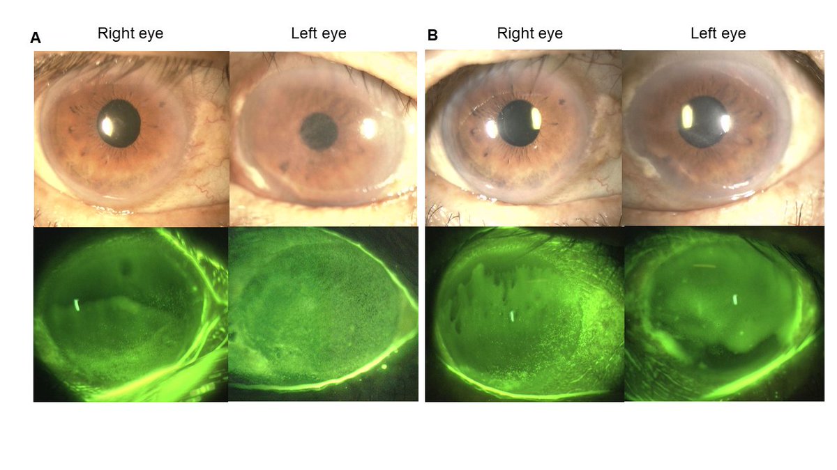 Documenta Ophthalmologica May Highlight rdcu.be/dEsRD vitamin A deficiency after cataract surgery @ClinMedJournals @Ophthalmologen @SN_Ophthalmol @ruthiedeh @BriSCEV