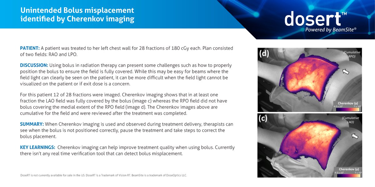 VisionRTLtd's tweet photo. Discover the power of Cherenkov imaging! 

This case study shows how Cherenkov imaging helped identify inconsistent bolus placement during treatment for a left breast patient. 

Dive into the details:  https://t.co/HQNBxO9gzp https://t.co/NnpRkXEtJV