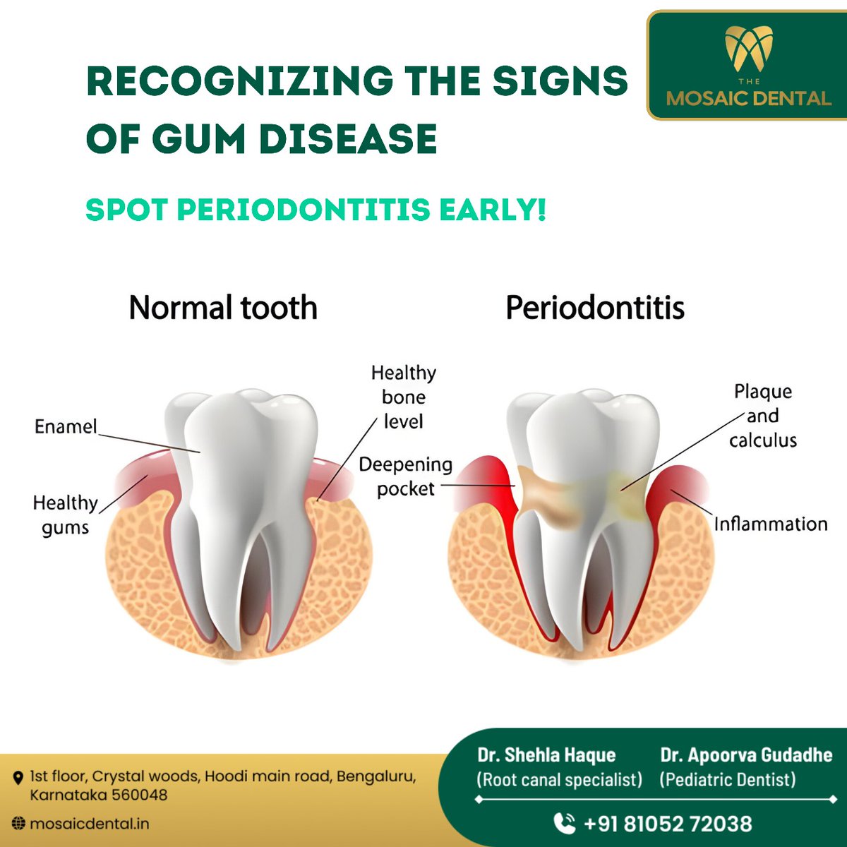 TheMosaicDental's tweet photo. 🦷 Don't ignore the warning signs! #GumDisease often starts silently, but left untreated, can lead to serious #Periodontitis.
🌐 https://t.co/nRqBxuW0ET
.
.
#TheMosaicDental #MosaicDental
#GumProblems #GumTreatment #Periodontist #GumHealth #InstaDentist #Bangalore #Karnataka https://t.co/KNEPZbSX1m