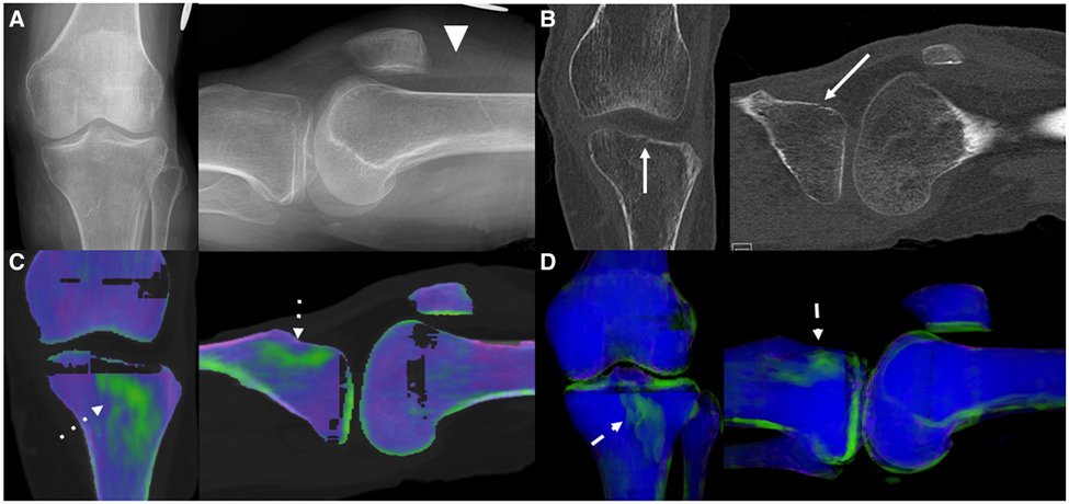 Review
Dual-energy CT applications in musculoskeletal disorders
bit.ly/3vIPEh3
#Radiology