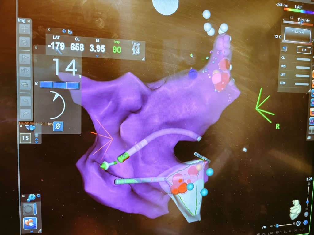 Moti_Haim's tweet photo. Great case today of GP ablation in a 27 year old woman with highly sympathetic functional AVB . Great remote support by Roman Piotrowski @PiotrowskiRoman and piotr kulakowski . Patient Wenkebach CL improved from 860 to 510ms and AH shortened from 220 to 120ms . Guided by ICE and https://t.co/OyH6LFZEoY
