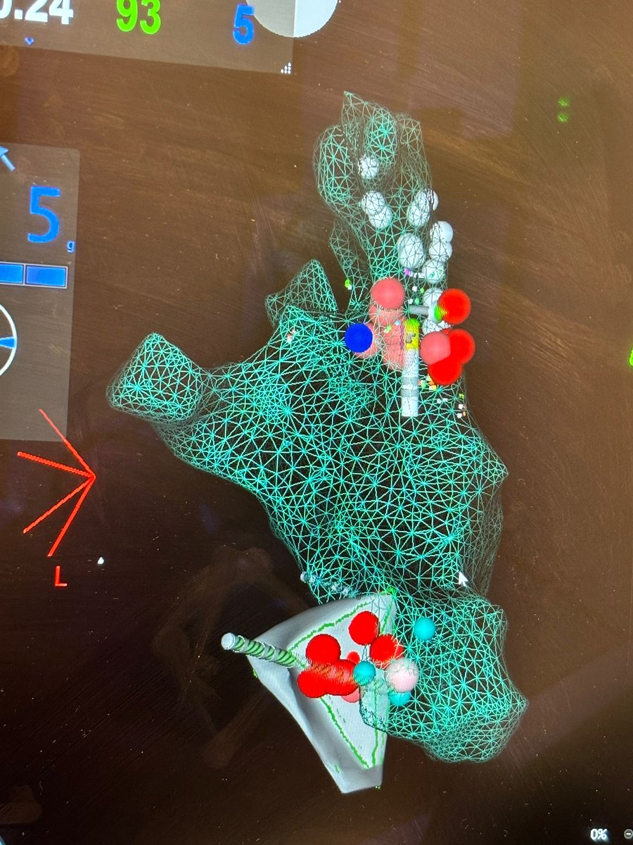 Moti_Haim's tweet photo. Great case today of GP ablation in a 27 year old woman with highly sympathetic functional AVB . Great remote support by Roman Piotrowski @PiotrowskiRoman and piotr kulakowski . Patient Wenkebach CL improved from 860 to 510ms and AH shortened from 220 to 120ms . Guided by ICE and https://t.co/OyH6LFZEoY