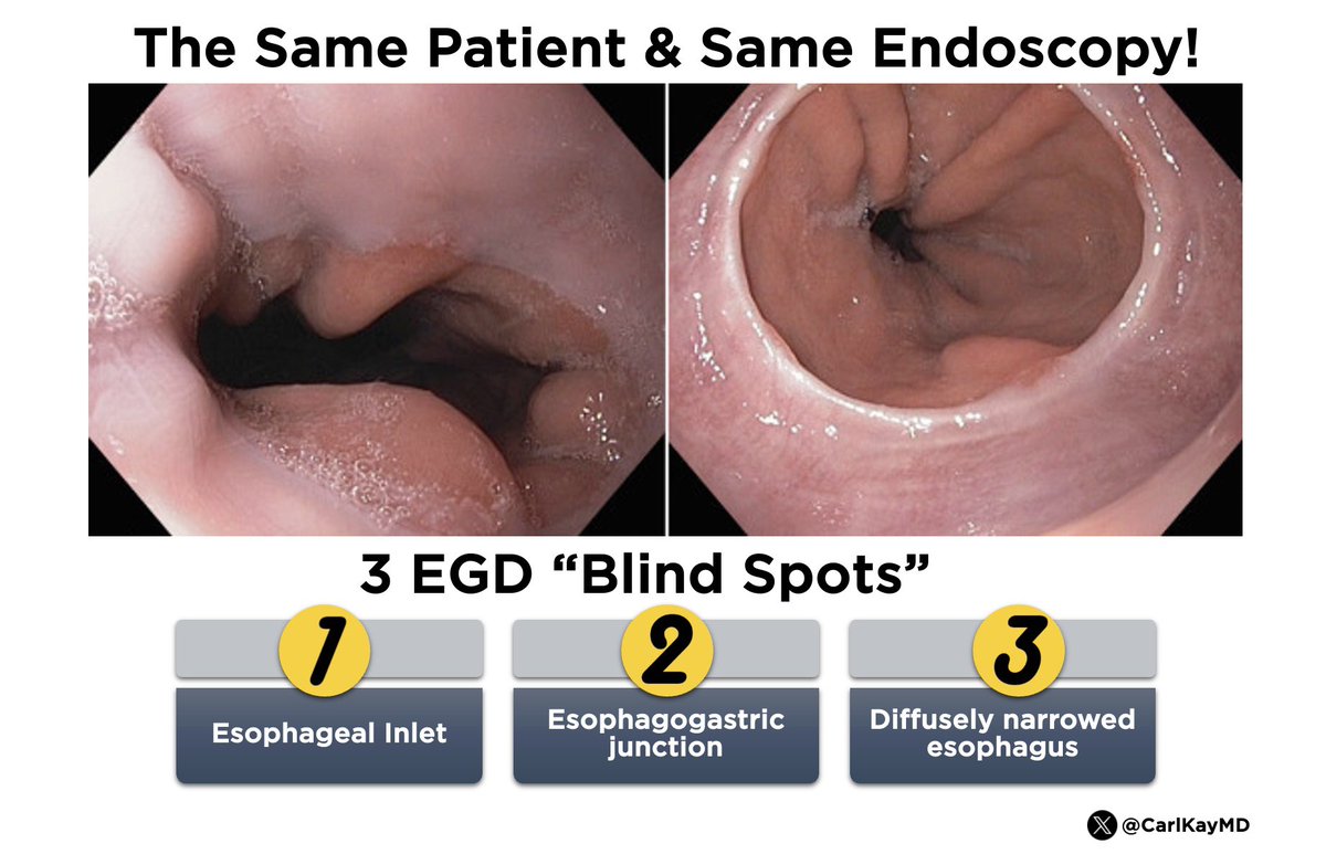 Blind Spots of EGD 

1️⃣ Esophageal Inlet
2️⃣ Esophagogastric junction
3️⃣ Diffusely narrowed esophagus

🧵How to mitigate each blind spot 👇

#GITwitter