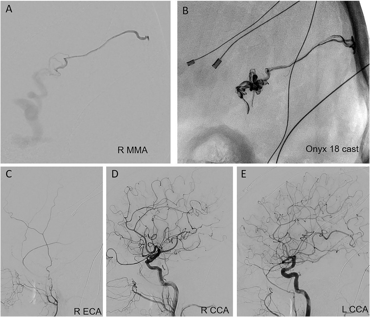 New for @INR_WFITN, our #cerebrovascular team presents a multicenter study on the clinical experience with the Scepter Mini balloon catheter using data from six North American cerebrovascular centers. @MMSalemMD @JanKarlBurkhar1 @visishs @GSSioutas ➡️ spr.ly/6018w4WXg