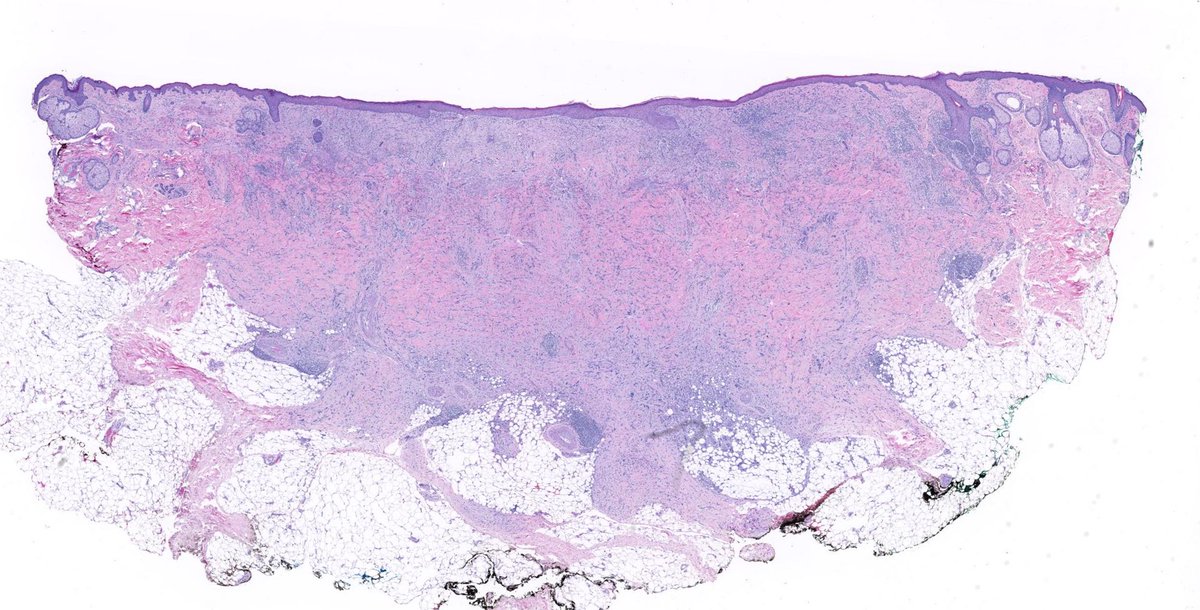 75 yo F cheek. Firm plaque. 
Digital slide: kikoxp.com/posts/6793. 
What clue can we see here (even at 2x magnification!) to instantly suspect this? 
Answer: youtu.be/2lQbrjpFtDk?si… 
#pathology #pathologists #pathTwitter #dermpath #dermatology #dermatologia #dermtwitter