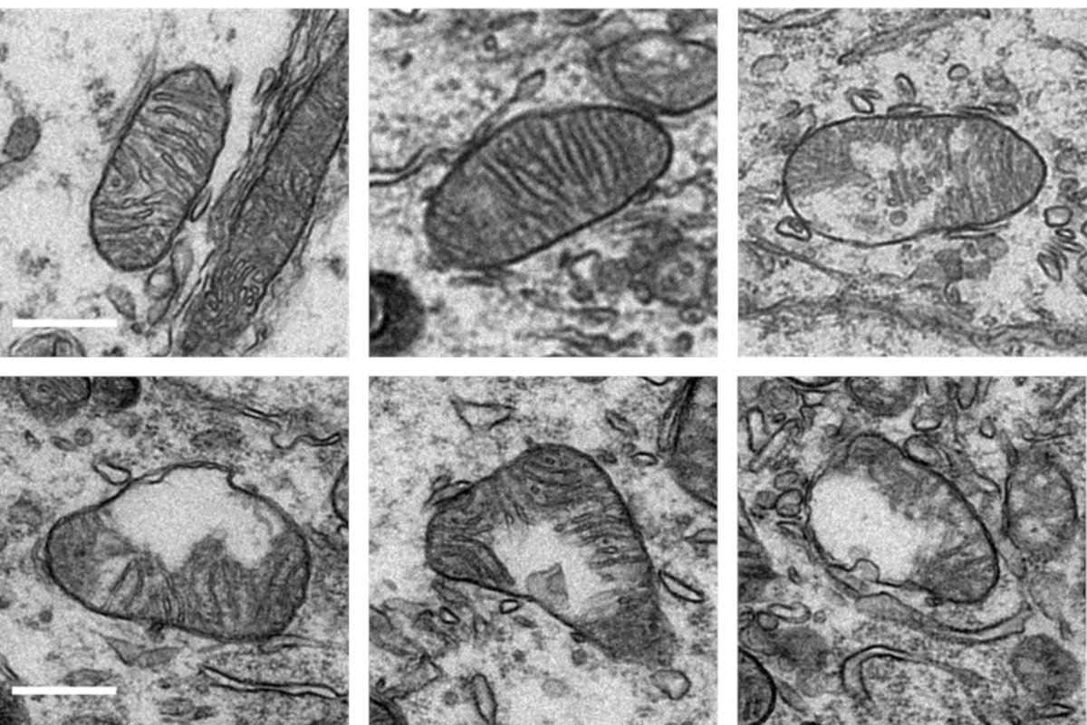 Researchers from @mcgillu @BioMcGill describe a discovery that suggests possible paths towards new treatments for a rare neurodegenerative disease which typically appears in adulthood and worsens over time 🧠 ➡️mcgill.ca/x/wUN