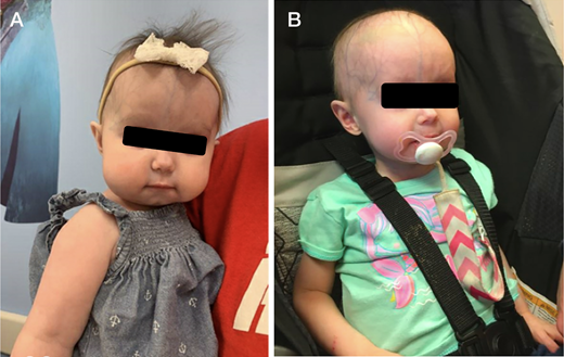 #PediatricsInReview | Skin Hardening and Eczema in a 9-month-old Girl: bit.ly/3VPe2Ie