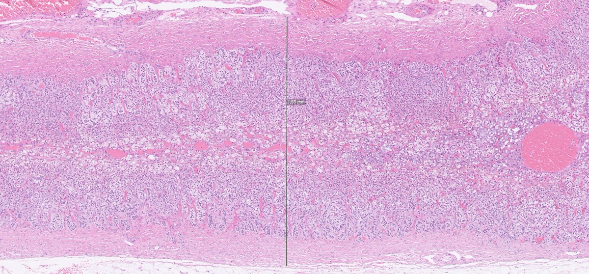 DrJuhlin's tweet image. One adrenal is from a patient with an endocrine disorder, the other adrenal has normal histology (an innocent bystander removed as part of ambitious surgery for unrelated purposes). Let's hear it in the polls below!