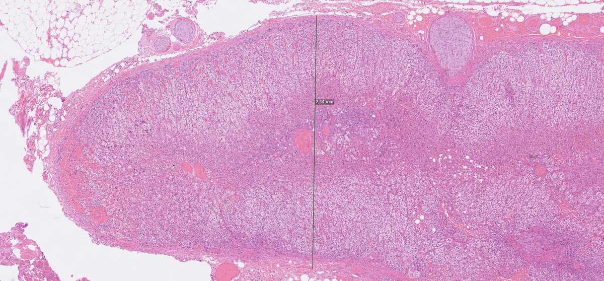 One adrenal is from a patient with an endocrine disorder, the other adrenal has normal histology (an innocent bystander removed as part of ambitious surgery for unrelated purposes). Let's hear it in the polls below!