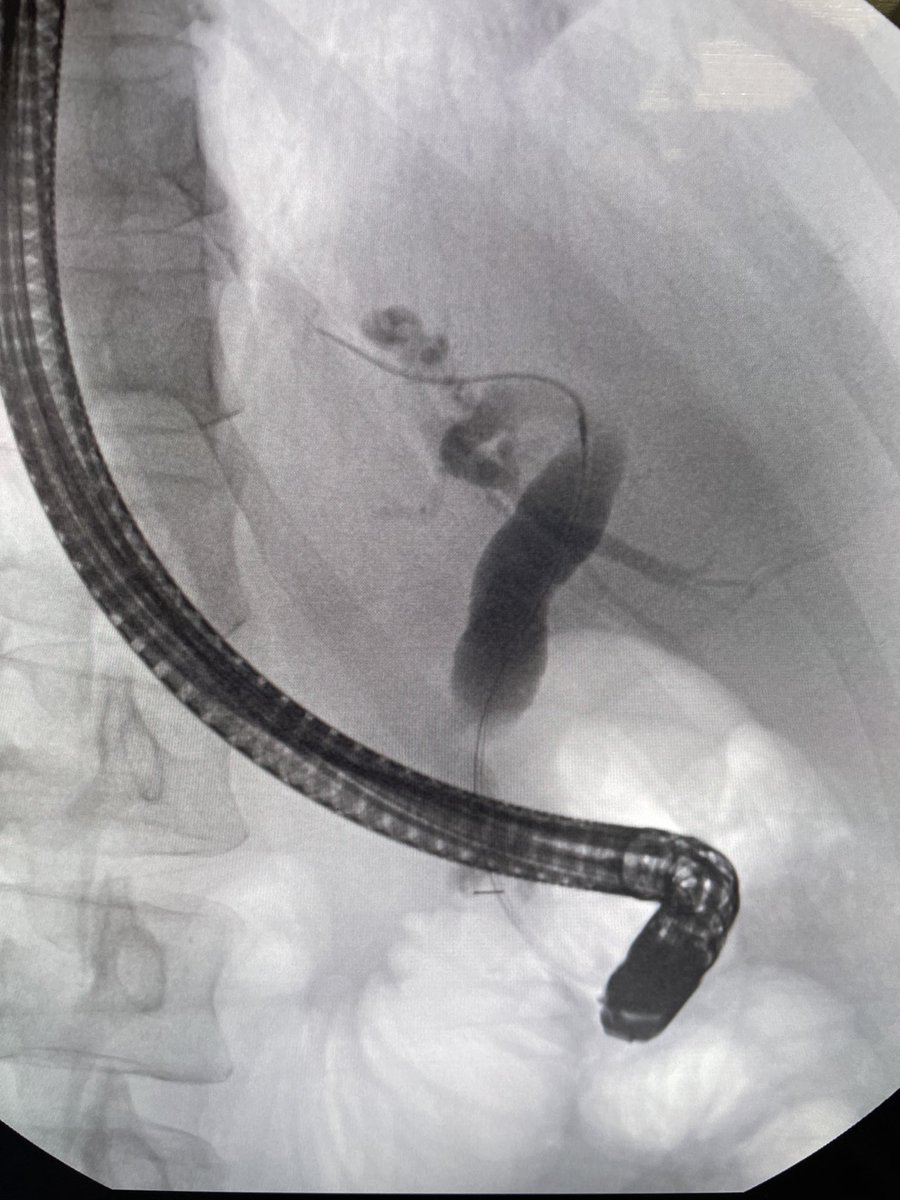 Impending biliary obstruction. Patient not jaundiced but has this cholangiogram. #gitwitter #surgery