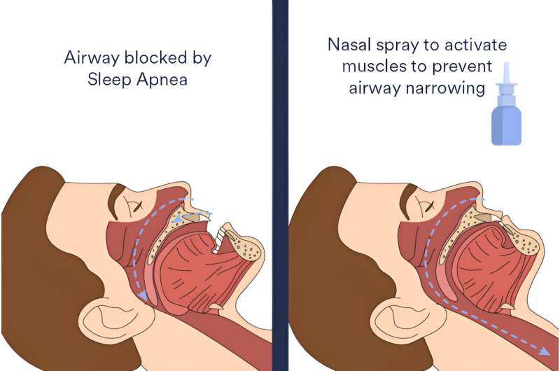 Exciting news for those of us interested in sleep health innovation! 🌙 A groundbreaking nasal spray is joining the fight against sleep apnea. 

Read all about it: medicalxpress.com/news/2024-03-n…

#SleepApnea #HealthInnovation #SleepHealth