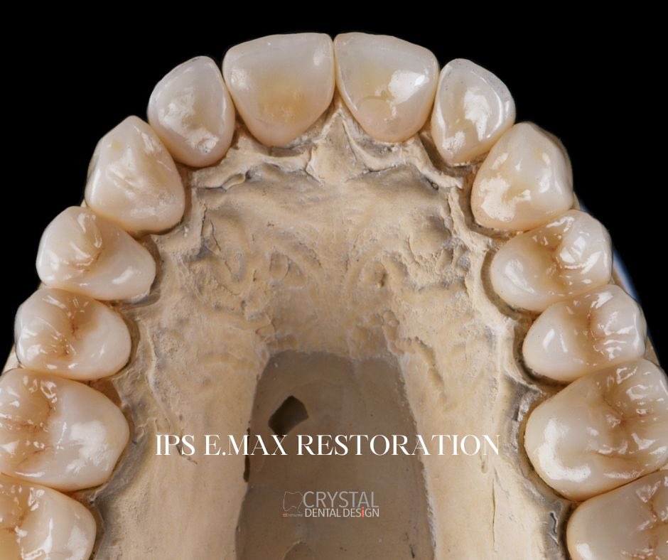 IPS e.max Restoration🦷
crystaldentaldesign.com 
crystaldentallab@gmail.com 
#crystaldentaldesign #dentallab #dentallaboratory #dentaltechnicians #dentists #vadentists #allceramiccrowns #allceramicaesthetics #zirconiacrowns #emaxcrowns #dmvdentists