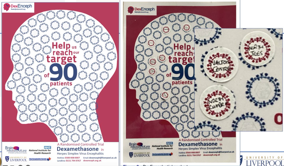 Do corticosteroids improve the outcome of Herpes Encephalitis? I’ll be answering this decades-old question at the @AANmember meeting tomorrow! #Encephalitis #BrainInfections