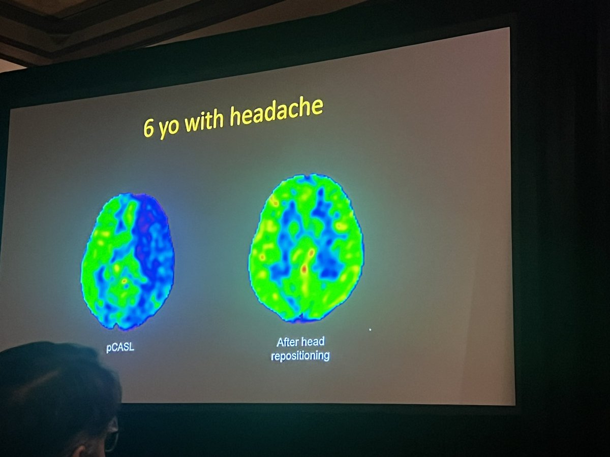 Dr Arastoo Vossough teaching all about ASL perfusion in #pedineurorad at SPR 2024. #pedsrad #neurorad