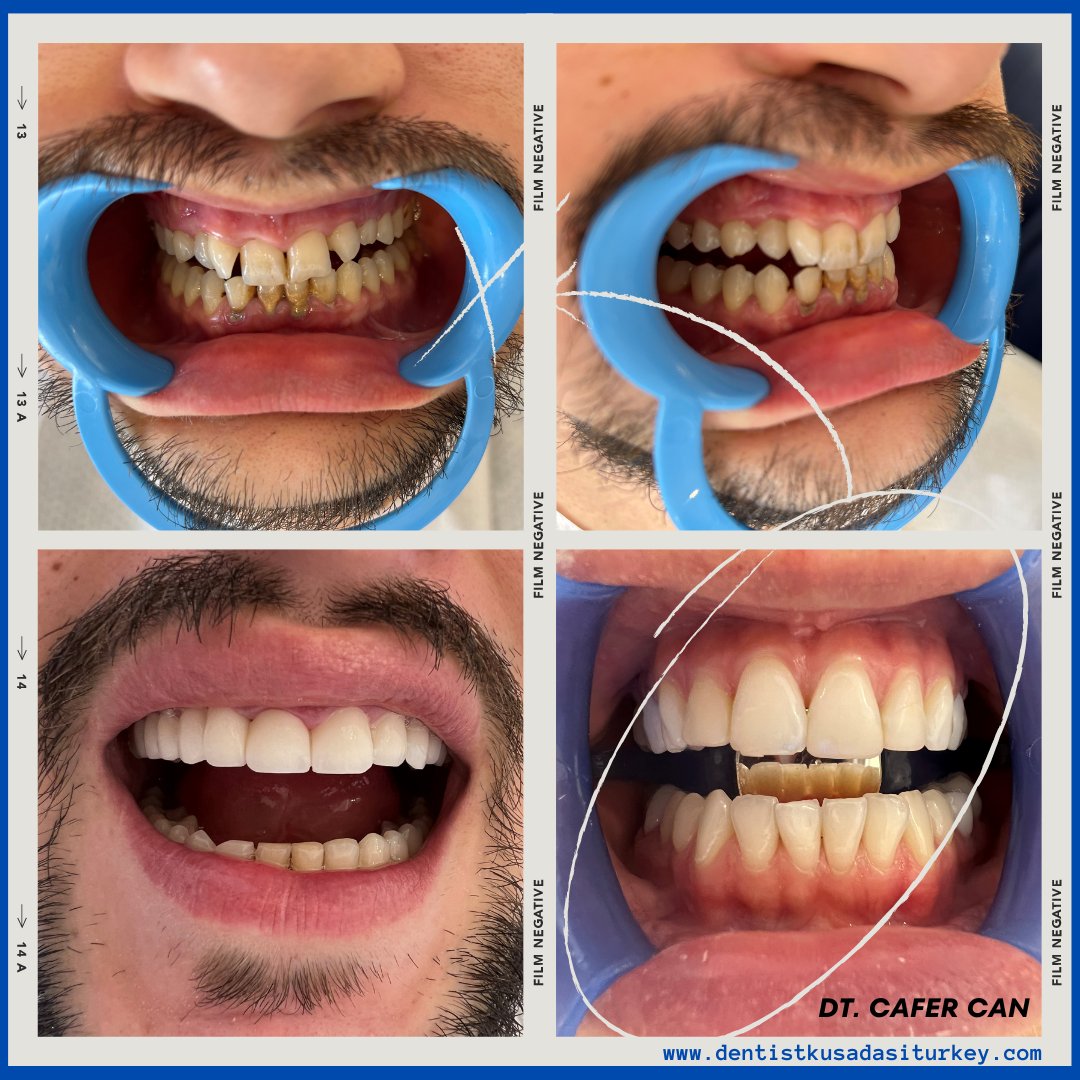 Transforming smiles one treatment at a time! Our patient underwent a stunning makeover with zirconium crowns and teeth whitening, revealing a radiant, confident smile. Swipe to see the incredible before and after transformation! #SmileMakeover #ZirconiumCrowns #TeethWhitening