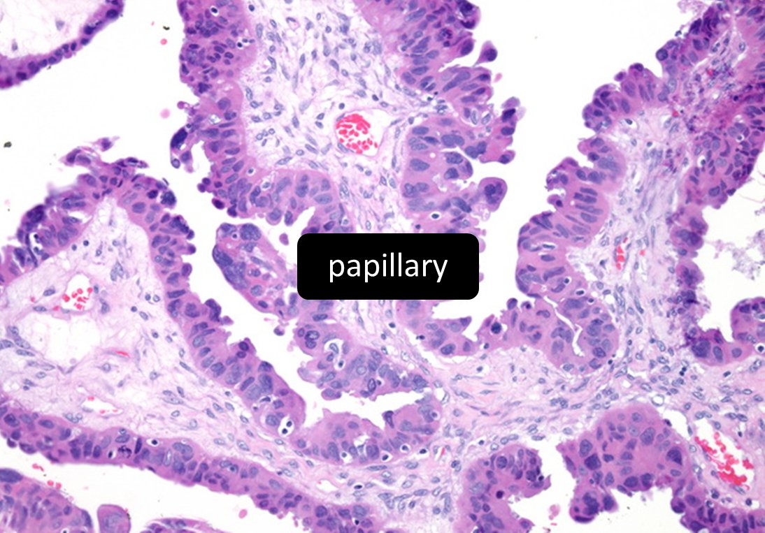 Deficiency in ___ repair can be associated with the __ pattern of ovarian high grade serous carcinoma.
A) mismatch
B) homologous recombination
#gynpath #pathresidents #PathTwitter  #pathology