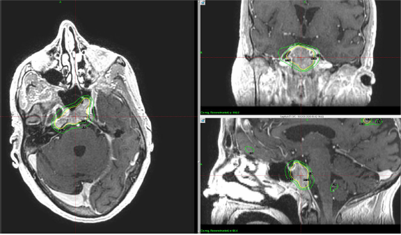 A new study in JNO on the role of Gamma Knife radiosurgery for clival metastasis.