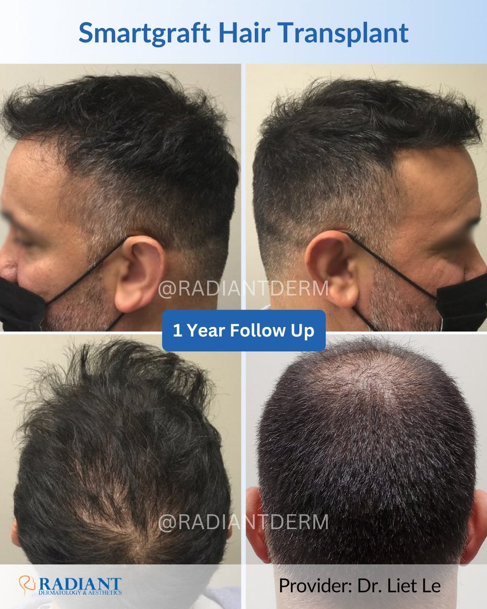 Radiantdermtx's tweet photo. Witness incredible transformations with SmartGraft Hair Transplant! See how this client achieved a thicker, fuller head of hair.

Book your appointment today with Dr. Liet Le. 
📞 281-973-4159 
📧 info@radiantdermtx.com
🌐 https://t.co/yZ1KkrugP1

#smartgraft #hairtransplant https://t.co/zqacPISyHj