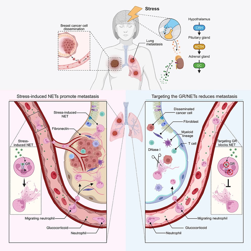 CellPressNews's tweet photo. Read the @Cancer_Cell Q&amp;A with Dr. Egeblad (@megeblad) about her recent paper on #ChronicStress increasing #metastasis: https://t.co/8wBf1bTR3F
Read the paper: https://t.co/X3nF2akwr8 https://t.co/ckklJ2zpBK