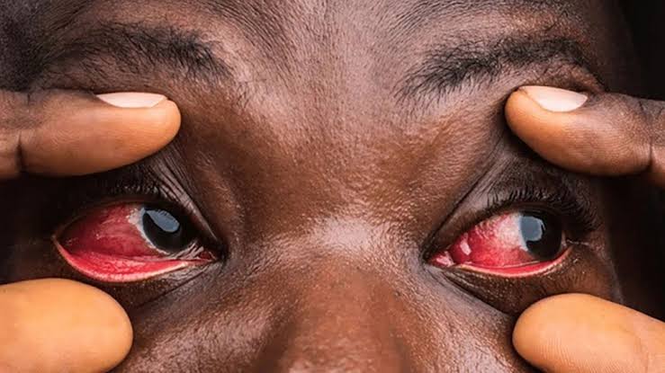 Be aware of the current wave of conjunctivitis (commonly known as pink eye) and take necessary precautions to protect yourself and others from contracting the virus. I have no special advice I would give beyond the usual: Prevention Is Better Than Cure.