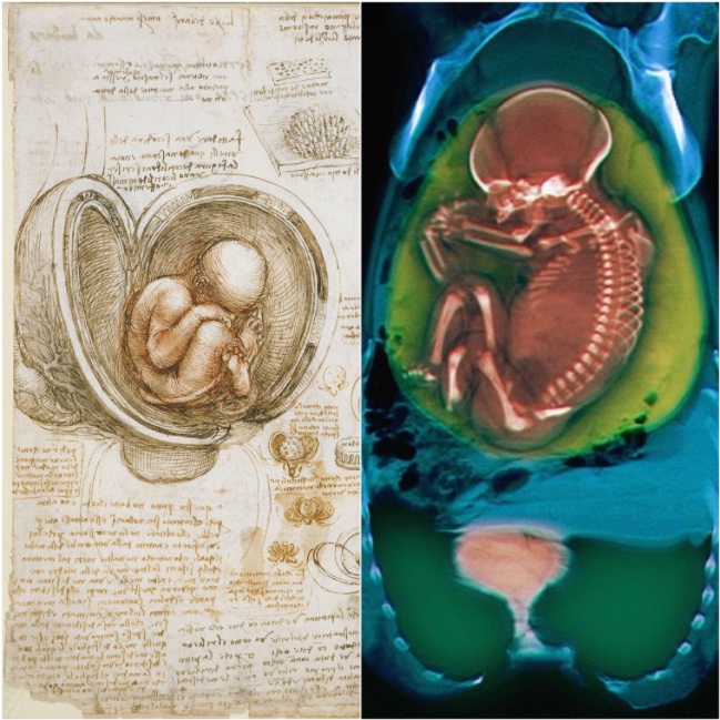 Leonardo astoundingly depicted the human fetus over 500 years ago, accurately illustrating its position within a dissected uterus. Comparison: CT scan of a pregnant woman with full term fetus (pictured left) and da Vinci's sketch of a baby inside the womb (pictured right).