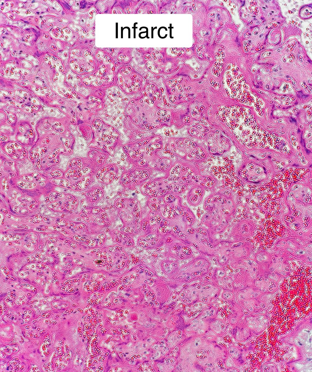 Path4People's tweet image. Ah, the confusion I still have in placental lesion 😵‍💫 

The perennial question (for me): perivillous fibrin deposition v. infarct  

Latter look for collapse of the intervillous space and ischemic necrosis (pyknosis, karyorrhexis, loss of nuclear staining)

#pathagonia #pedipath